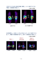 厚生労働科学研究費補助金（難治性疾患克服研究事業） 「Menkes 病・occipital horn 症候群の実態調査、早期診断基準確立、治療法開発に関する研究」 平成23年度 総括・分担研究報告書